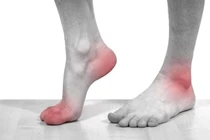 Dấu hiệu chứng tỏ bạn đã mắc bệnh gout