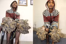 Bệnh "người cây" lần đầu phát hiện ở Việt Nam nguy hiểm thế nào?