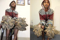 Bệnh "người cây" lần đầu phát hiện ở Việt Nam nguy hiểm thế nào?