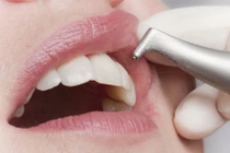 Mẹo chữa đau răng tại nhà bạn nên biết