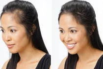Các nàng phải nghĩ lại khi muốn cấy ghép tóc nếu biết 7 sự thật này!