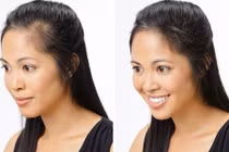 Các nàng phải nghĩ lại khi muốn cấy ghép tóc nếu biết 7 sự thật này!
