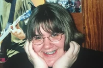 Bất ngờ căn bệnh khiến người phụ nữ mọc lông tua tủa