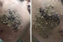 Da mặt biến thành 'bánh đa' vì nghiện sử dụng nước hoa hồng