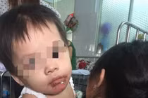 Bé gái 18 tháng bỏng nặng ở miệng, mẹ tố do bảo mẫu