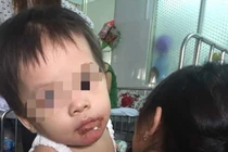 Bé gái 18 tháng bỏng nặng ở miệng, mẹ tố do bảo mẫu