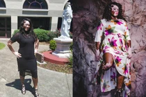 Từng muốn tự tử vì làn da loang lổ, cô gái vươn lên thành người mẫu