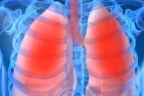 Tiến hành thử nghiệm vắc-xin ung thư phổi