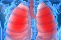 Tiến hành thử nghiệm vắc-xin ung thư phổi