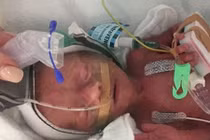 Sự hồi sinh kỳ diệu của bé gái sinh non