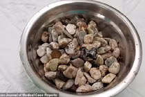 Kinh ngạc lấy ra 2kg đá sỏi, nắp chai trong dạ dày người đàn ông 