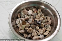 Kinh ngạc lấy ra 2kg đá sỏi, nắp chai trong dạ dày người đàn ông 