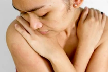 Cách trị mẩn đỏ trên cơ thể hiệu quả không cần dùng thuốc