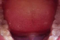 Vi khuẩn trong miệng có thể gây ung thư ruột kết