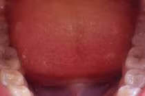 Vi khuẩn trong miệng có thể gây ung thư ruột kết