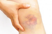 Xuất hiện những vết bầm bất thường bạn phải đến bệnh viện ngay