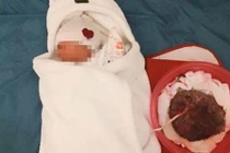 "Sinh thuận tự nhiên” sau 6 giờ em bé chưa được cắt dây rốn, nguy hiểm tính mạng
