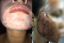 Hoảng hồn những gương mặt biến dạng vì dùng nước lột da tẩy trắng 
