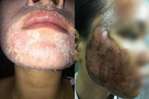 Hoảng hồn những gương mặt biến dạng vì dùng nước lột da tẩy trắng 