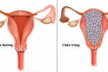 Bệnh lạ khiến mẹ hiếm muộn “mừng hụt”, đối mặt với mối nguy hiểm