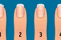 Thay đổi móng tay cảnh báo tình trạng sức khỏe nghiêm trọng