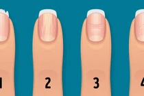 Thay đổi móng tay cảnh báo tình trạng sức khỏe nghiêm trọng
