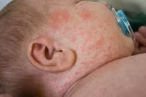 Trẻ tử vong nghi do sốt xuất huyết: Làm sao biết con ở giai đoạn nguy hiểm?