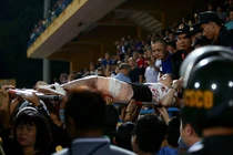 Fan nữ trúng pháo sáng CĐV Nam Định: Di chứng, phục hồi chức năng ra sao?