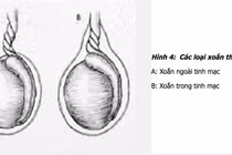 Đột ngột đau dữ dội 'hạt cà', thiếu niên 14 tuổi mất cơ hội làm cha