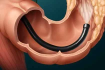 Nội soi ngăn ngừa 40% ung thư đại trực tràng