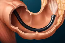 Nội soi ngăn ngừa 40% ung thư đại trực tràng