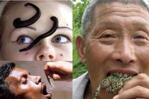 Những cách chữa bệnh kỳ dị nhất thế giới (1)