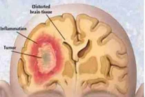 Tín hiệu cảnh báo sớm của ung thư não