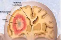 Tín hiệu cảnh báo sớm của ung thư não