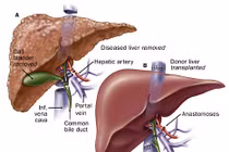 Tìm hiểu về ung thư gan nguyên phát đa ổ