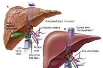 Tìm hiểu về ung thư gan nguyên phát đa ổ