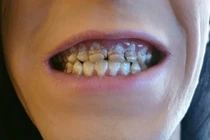 Chàng trai bị mục nát hàm răng vì lý do nhiều người dễ mắc