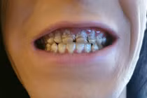 Chàng trai bị mục nát hàm răng vì lý do nhiều người dễ mắc