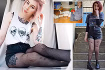 Mắc bệnh hiếm, cô gái phải đóng gim chân để đi lại