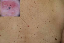 70%: nam giới chết vì ung thư da cao hơn phụ nữ