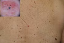 70%: nam giới chết vì ung thư da cao hơn phụ nữ