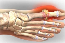 Những đồ ăn làm giảm cơn đau của người bệnh gout
