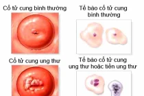 Các triệu chứng của ung thư cổ tử cung
