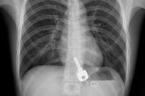 Đau ngực dữ dội, thanh niên vội đến bác sĩ và phát hiện gây sốc sau đêm say xỉn