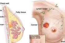 Ung thư vú thường xảy ra ở độ tuổi nào? 