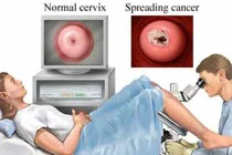 Ung thư cổ tử cung là gì?