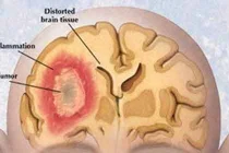 Phát triển công nghệ mới phát hiện sớm bệnh u não