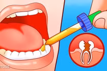 10 mẹo giảm đau hiệu quả khi mọc răng khôn