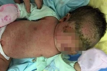 Hiểm họa tiềm ẩn khi tắm bằng lá cho trẻ