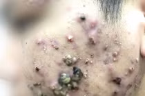 Mặt chi chít mụn mủ vì dùng kem trị trứng cá mua qua mạng